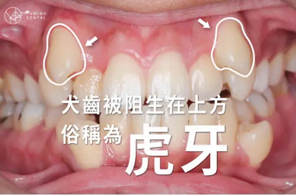 虎牙虎牙指什么？如何避免搜索混淆